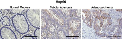 Hsp60 Immunohistochemical Pattern In Large Bowel Tumors Download