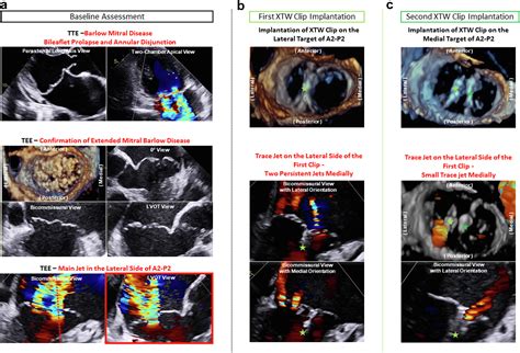 Percutaneous Transcatheter Edge To Edge Mitral Valve Repair With