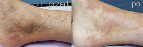 Skleroterapia piankowa - leczenie żylaków telangiektazji | Venavita Poznań