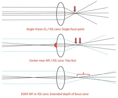 Extended Depth Of Focus Optics A Guide For Optometrists