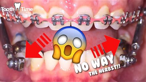 Dental Braces Herbst Appliance Tooth Time New Braunfels Texas