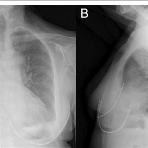 Case 1 Posteroanterior A And Lateral B Chest X Ray Enlarged