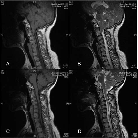 Mri Of Chiari Malformation Type I A And B Oda Is Close To A Right