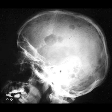 Pediatric Multiple Myeloma Pediatric Radiology Reference Article Pediatric Imaging