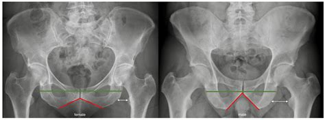 The Differences Between The Male And Female Pelvis 54 Off