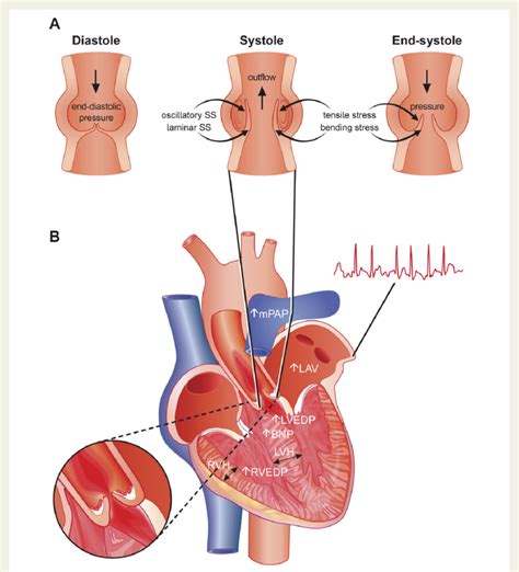 Hemodynamic Flow Across The Aortic Valve And Myocardial Alterations