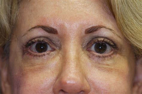 Short Scar Facelift And Lower Blepharoplasty