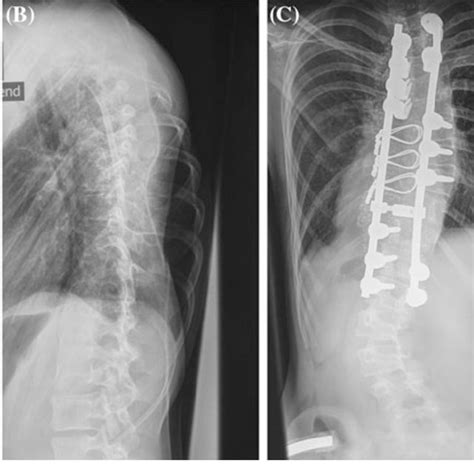 A 13 Year Old Girl With Fast Progressive Adolescent Idiopathic Download Scientific Diagram