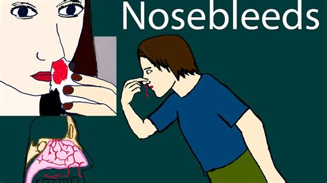 Nosebleeds Epistaxis Types Causes Treatment Prevention YouTube