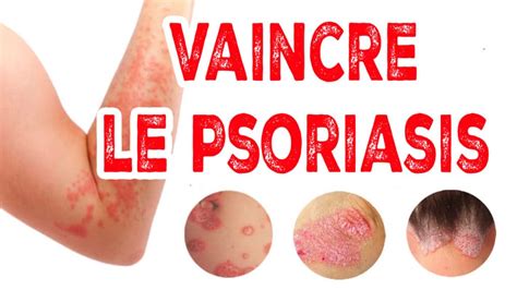 Vaincre Le Syndrome De Gougerot Sjogren Naturellement BMoove