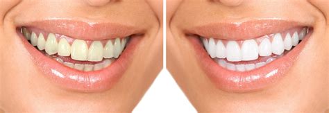 Tratamiento de Blanqueamiento Dental Combinado en qué consiste