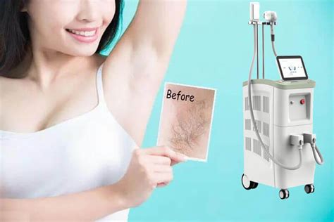 Best Professional Laser Hair Removal Machine In Clinics Do You Know