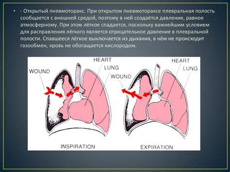 Пневмоторакс и первая помощь - презентация онлайн