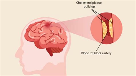 What Are The Symptoms Of Frontal Lobe Damage NutritionFact In