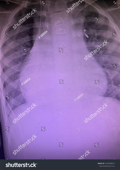 Film Xray Show Right Lung Pneumothorax Stock Photo 1995398810