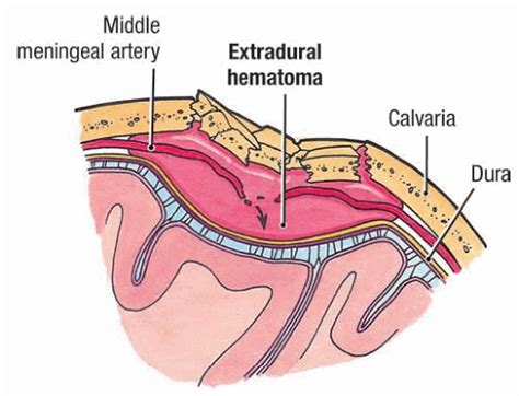 Epidural Hematoma Middle Meningeal Artery