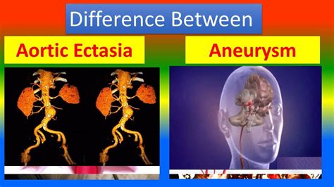 Difference between Aortic Ectasia and Aneurysm - YouTube