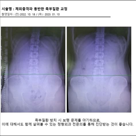 천안정형외과잘하는곳 족부질환 정형외과 전문의에게 보존적 요법 받을 수 있는 곳 네이버 블로그