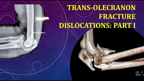 Trans Olecranon Fracture Dislocations Part I Non Graphic Youtube