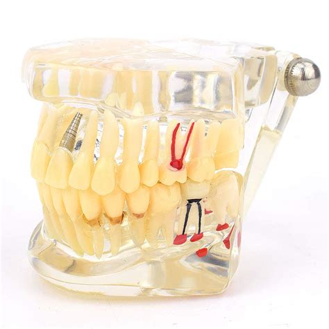 Buy Dental Tooth Model Dental Demonstration Teeth Model Restoration