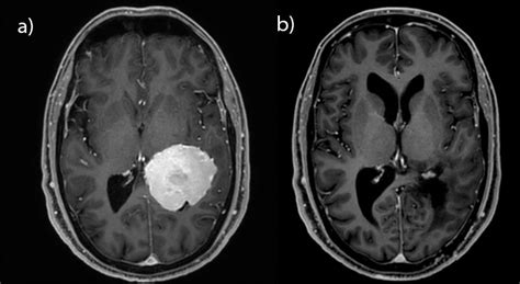 Hirntumor Gehirntumor Diagnose Und Behandlung Ksw