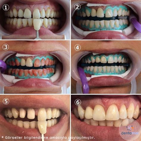 Diş Beyazlatma Bleaching Dentamar Erenköy Ağız ve Diş Sağlığı