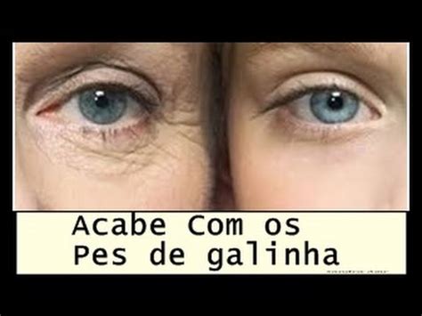 Acabar As Rugas Na Area Dos Olhos Pes De Galinha Palpebra Caida E