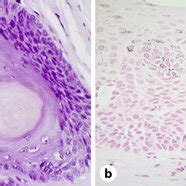 A H E Stain Section High Power Evaluation Of The Matrix Biopsy Shows