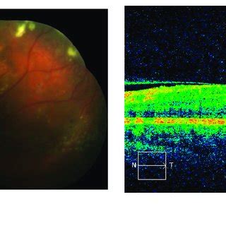 Fundus Photograph A And Sd Oct Macular Scan B Of Patient After