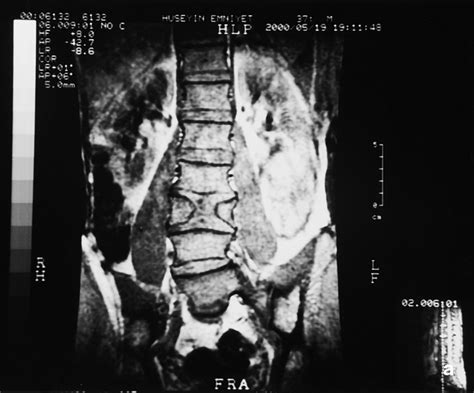 Butterfly Vertebra A Case Report Clinical Imaging