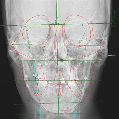 Postoperative Frontal Cephalometric X Ray Shows That The Facial