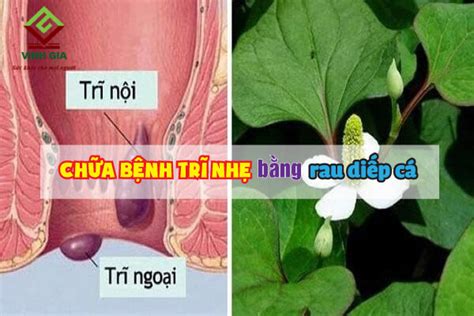 Bệnh Trĩ Nhẹ Là Gì Dấu Hiệu Nhận Biết Và Cách điều Trị Hiệu Quả