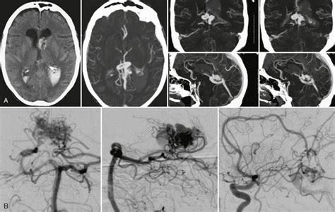 Vascular Malformations Radiology Key