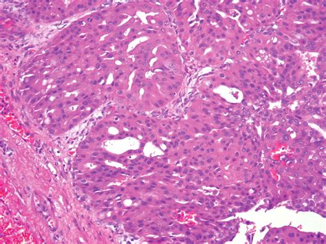 Intraductal Papillary Mucinous Neoplasms Of The Pancreas Clinical And Pathological Features And