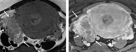 A 51 Year Old Woman With Stage Iiia Endometrial Cancer A Axial T2wi