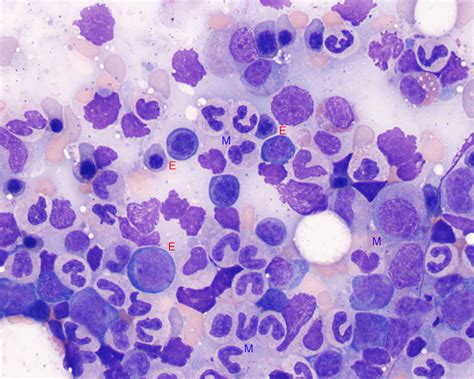 Myeloid To Erythroid Ratio EClinpath