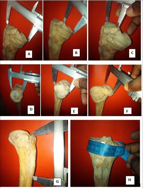 Measurement Of Transverse Diameter Of Total Tibia Condyle Figure 1a Download Scientific