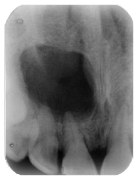 Pre Operative IOPA Radiograph Showing Well Defined Large Periapical