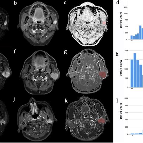 Representative Images Of A 57 Year Old Woman With Pleomorphic Adenoma