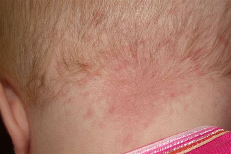 Birthmarks Types Causes And How To Care For Them