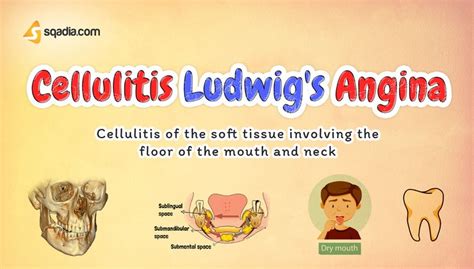 Cellulitis Ludwig’s Angina Pathology Video Lecture