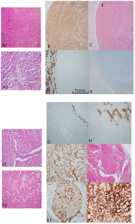 Clear Cell Papillary Renal Cell Carcinoma A In Clear Cell