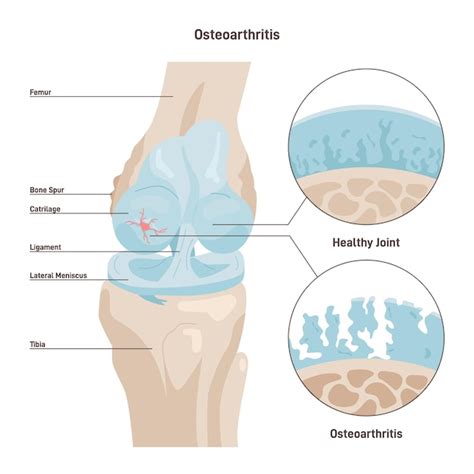 Premium Vector | Osteoarthritis Degenerative joint disease Worn out ...