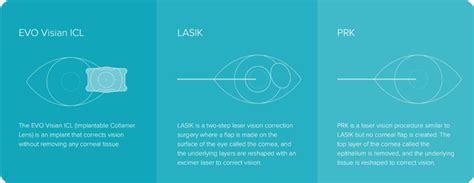 Prk Surgery In Sacramento California Lasik Eye