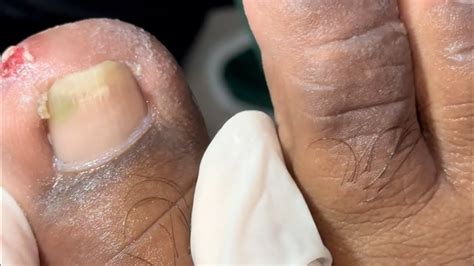 Ep6044 Ingrown Toenail Removal 👣 ลุ้นกันนะทะลุ หรือ ไม่ 😊 Clip From