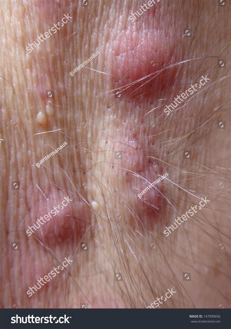 Acne Inversa Hidradenitis Suppurativa Armpit Stock Photo 147990656