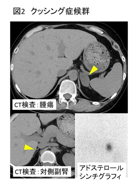 副腎腫瘍｜泌尿器の病気について｜患者さんへ｜長崎大学病院 泌尿器科・腎移植外科