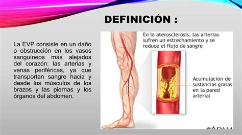 Enfermedad vascular periférica 22 4 final pptx