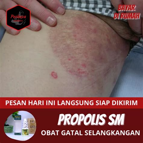 Detail Gambar Jamur Tinea Cruris Koleksi Nomer 47