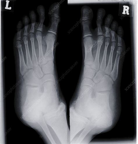 Human Feet X Ray Stock Image F0298812 Science Photo Library